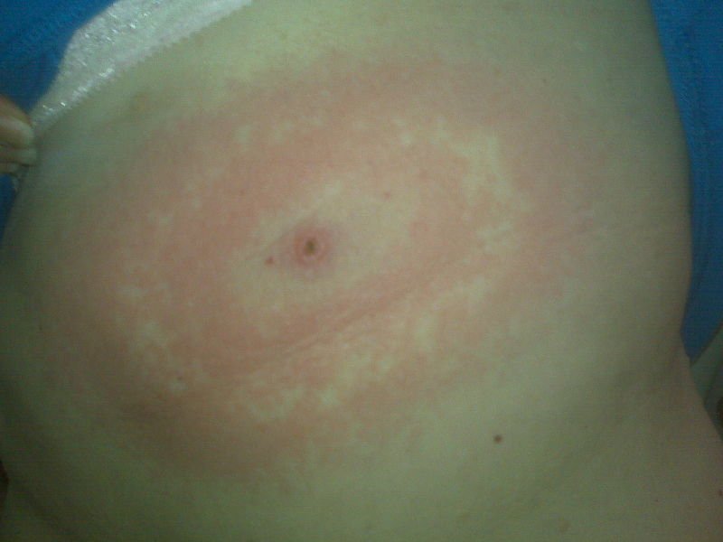 Zeckenstich Borreliose Zecken